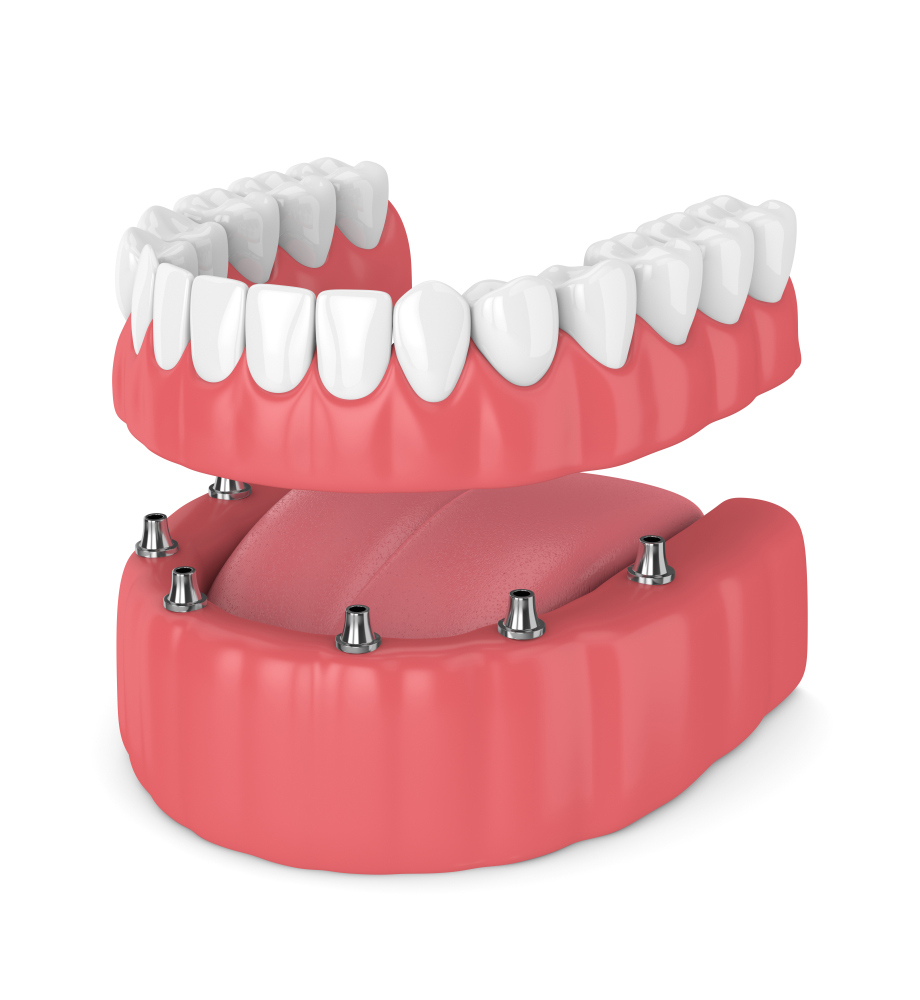 Dentures